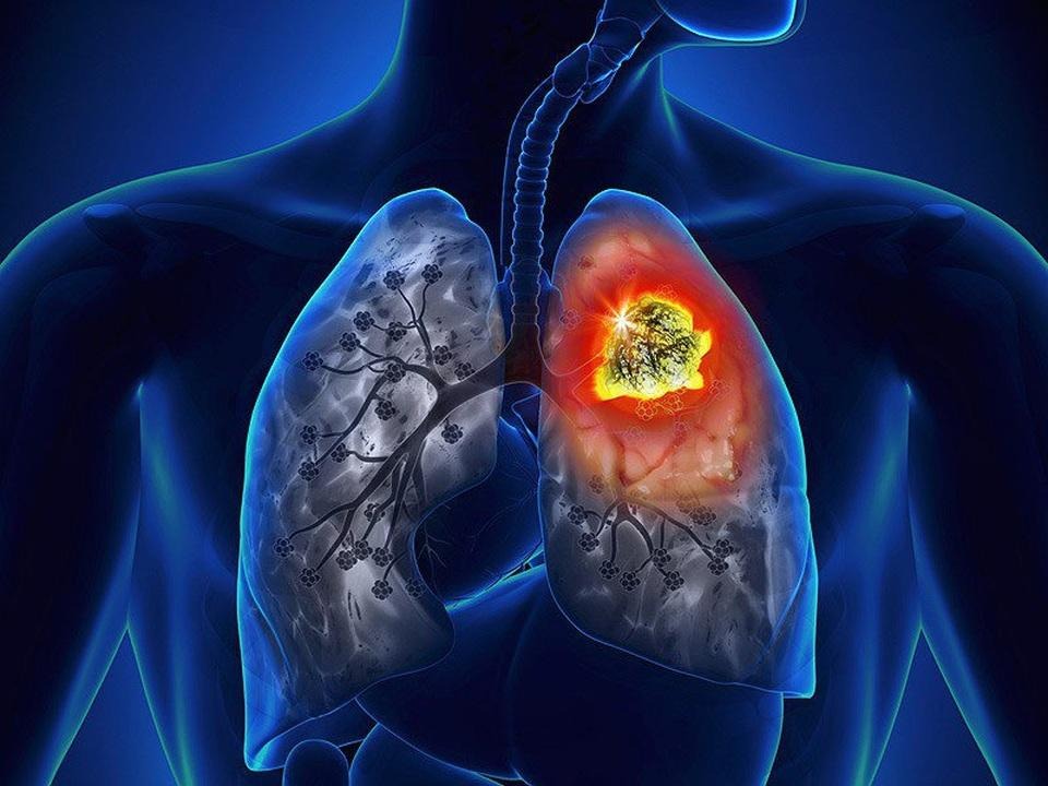 Lung Cancer Awareness